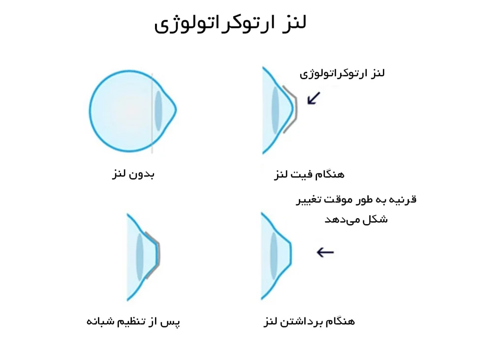 ارتوکراتولوژی